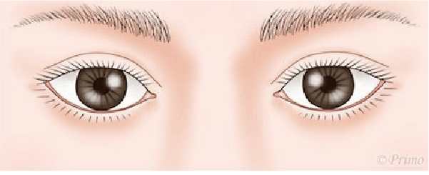 二重修正術 後の目元イラスト